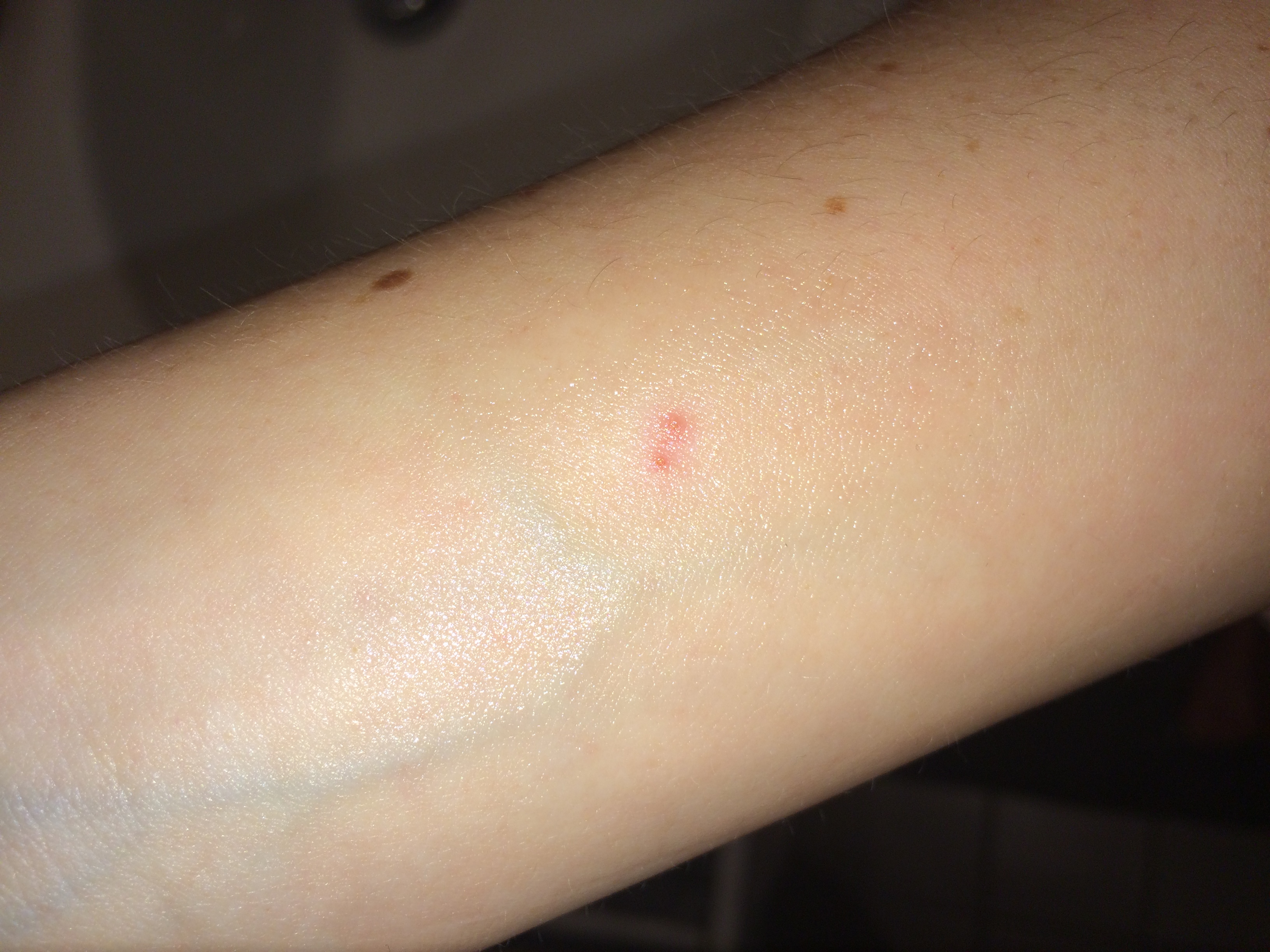 Bisse? Stiche? Zwei kleine Löcher im gleichen Abstand (5mm)? (Stich) Bisse? Stiche? Zwei kleine Löcher im gleichen Abstand (5mm)? (Stich)