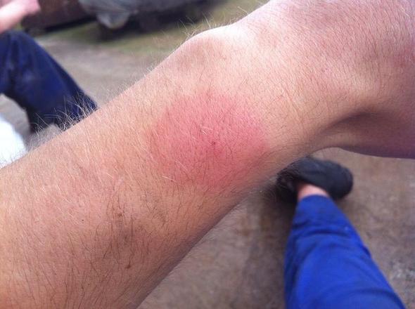 Biss Stich Mit Riesigem Roten Kranz Drum Rum Krankheit Insekten Biss Stich Mit Riesigem Roten Kranz Drum Rum Krankheit Insekten