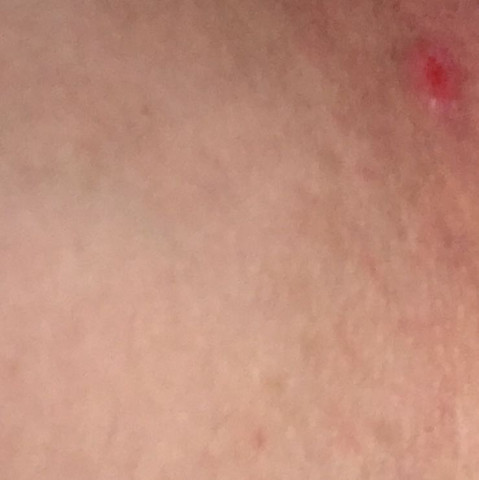 Bitte Den Beitrag Lesen Gesundheit Und Medizin Pickel Intimbereich Bitte Den Beitrag Lesen Gesundheit Und Medizin Pickel Intimbereich