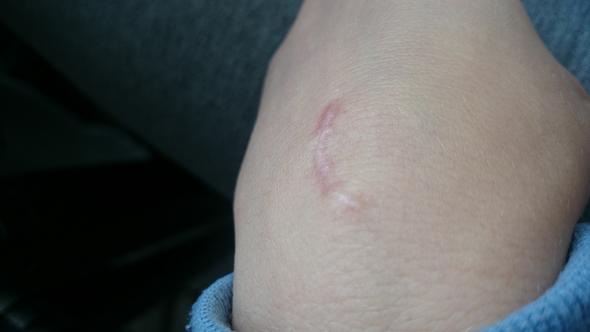 Bitte Hilfe Kommt Es Zuruck Ganglion Uberbein Bitte Hilfe Kommt Es Zuruck Ganglion Uberbein