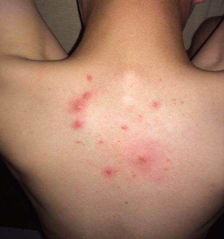 26+ Flecken Nach Pickel Ausdrücken Images