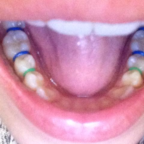 Bitte Irgendwas Gegen Diese Verblodeten Schmerzen Tun Zahnspange Zahnfleisch Gummi Bitte Irgendwas Gegen Diese Verblodeten Schmerzen Tun Zahnspange Zahnfleisch Gummi