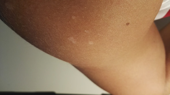 Weiße Flecken die meistgelesenen Fragen Weiße Flecken die meistgelesenen Fragen