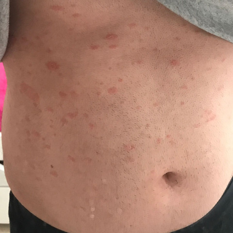 Bitte Um Hilfe Ist Das Ne Allergische Reaktion Gesundheit Und Medizin Allergie Hautausschlag Bitte Um Hilfe Ist Das Ne Allergische Reaktion Gesundheit Und Medizin Allergie Hautausschlag