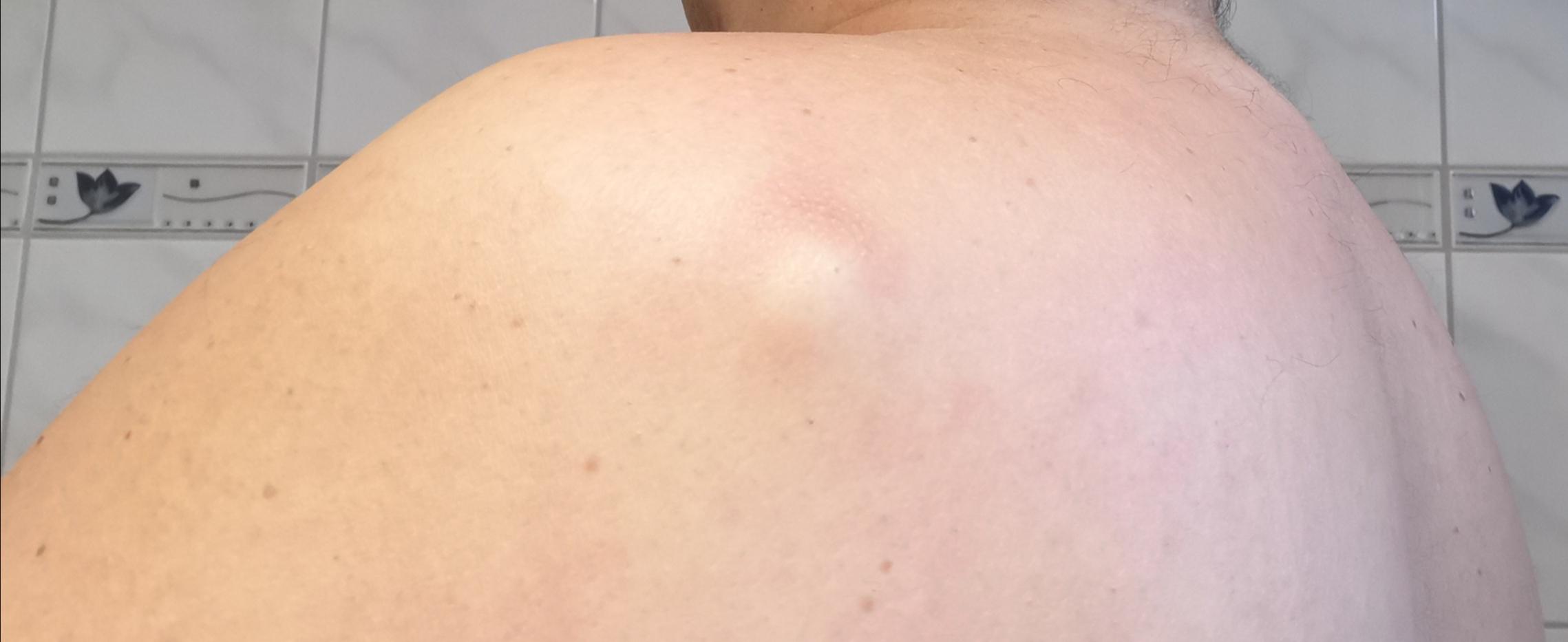 Bitte Um Hilfe Was Ist Das Beule Am Rucken Schulter Gesundheit Und Medizin Lipom Bitte Um Hilfe Was Ist Das Beule Am Rucken Schulter Gesundheit Und Medizin Lipom