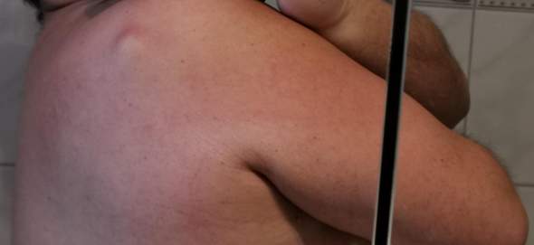 Bitte Um Hilfe Was Ist Das Beule Am Rucken Schulter Gesundheit Und Medizin Lipom Bitte Um Hilfe Was Ist Das Beule Am Rucken Schulter Gesundheit Und Medizin Lipom