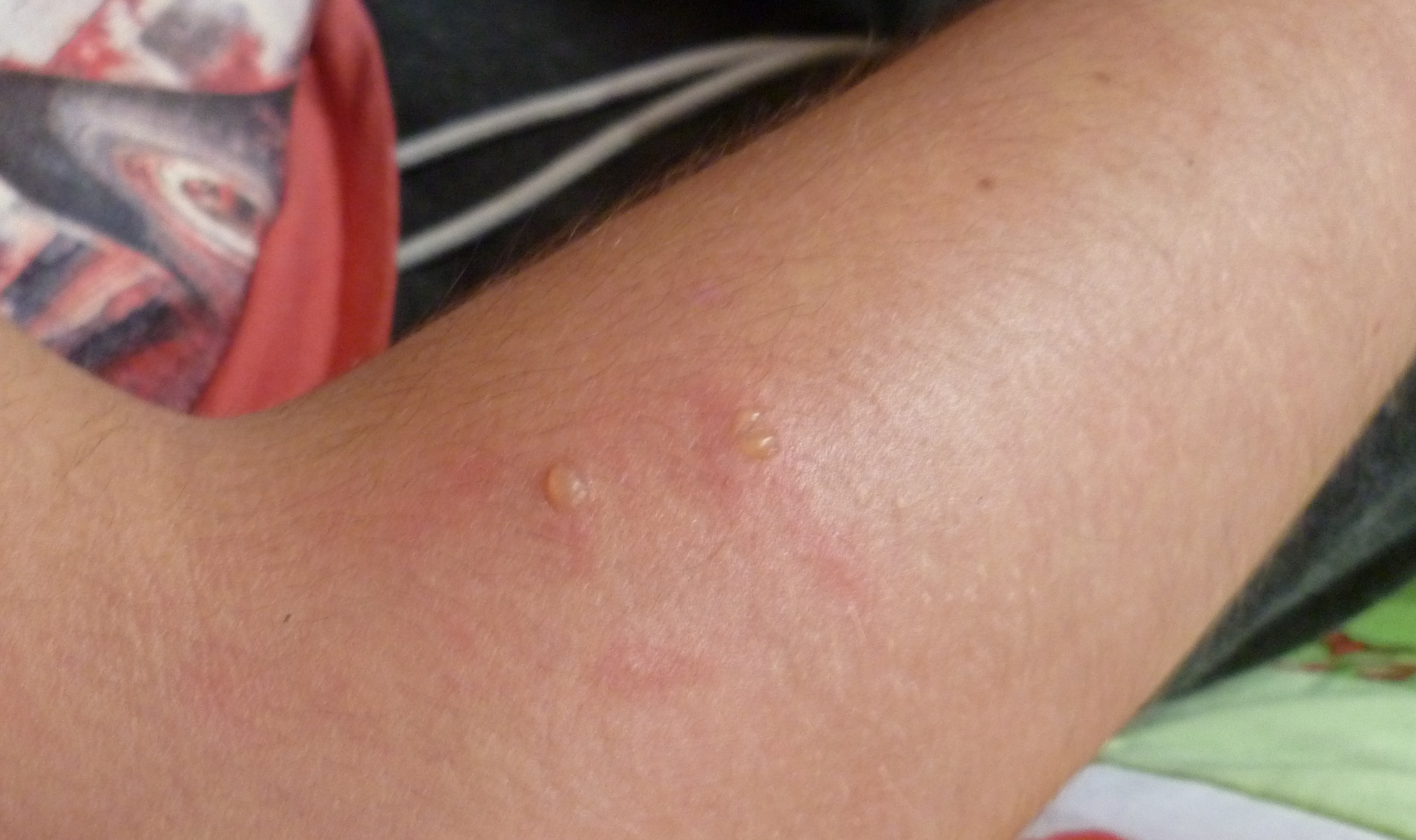 Bläschen am Arm?! (Allergie, blaeschen) Bläschen am Arm?! (Allergie, blaeschen)