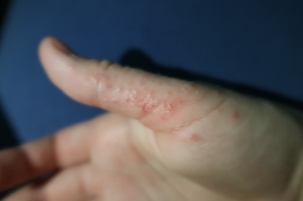 Blaschen Am Daumen Was Tun Gesundheit Und Medizin Krankheit Bilder Blaschen Am Daumen Was Tun Gesundheit Und Medizin Krankheit Bilder