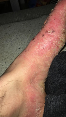 - (Gesundheit und Medizin, Bläschen am Fuss )