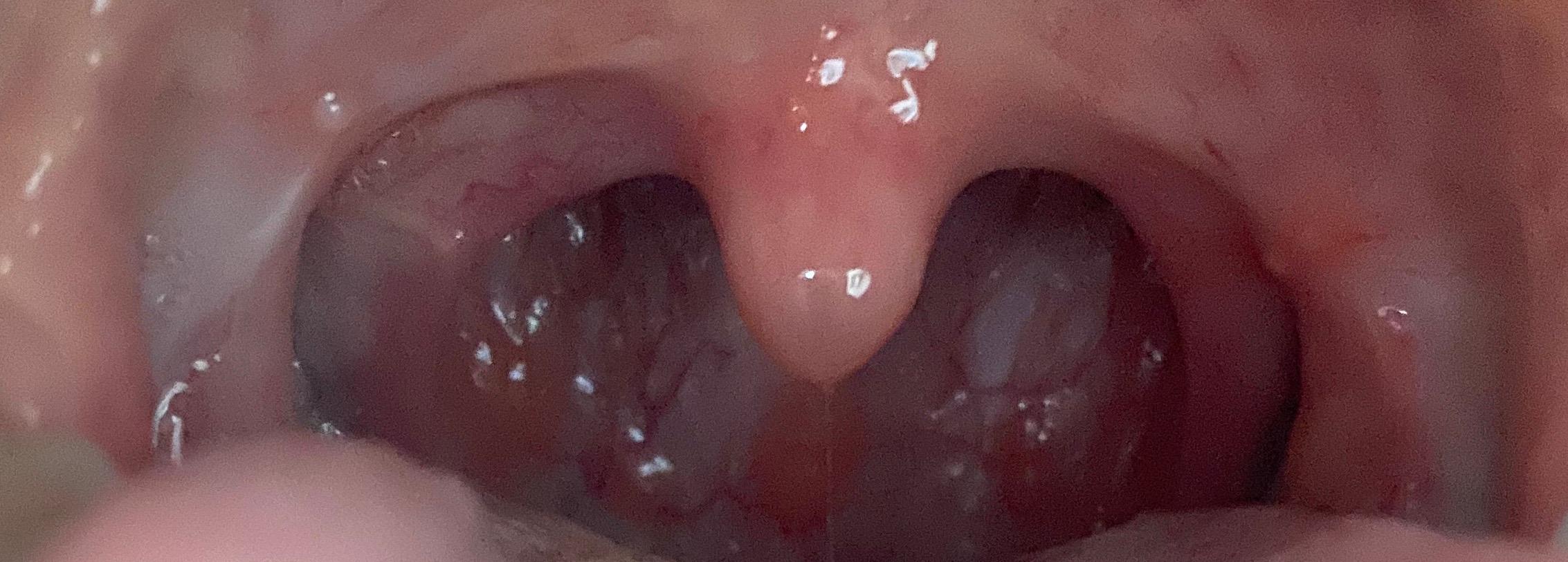 32++ Blaeschen am gaumen bilder , Bläschen am gaumen? (Gesundheit und Medizin, Mund, blaeschen)