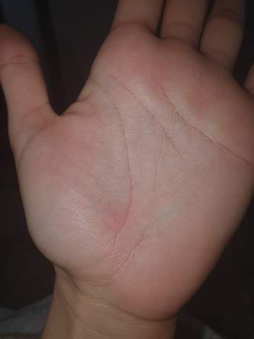 Blaschen Am Hand Blaschen Am Hand