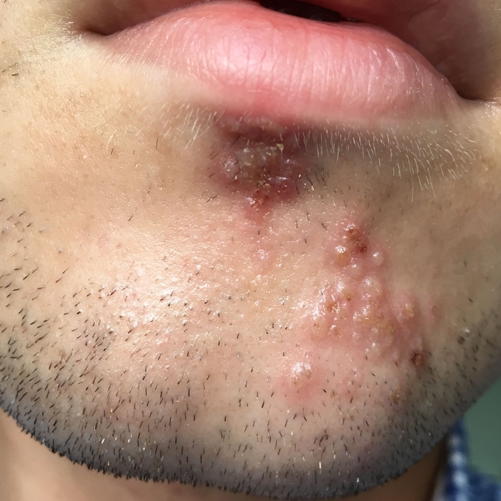 Download Pickel An Der Lippe Geht Nicht Weg Pictures