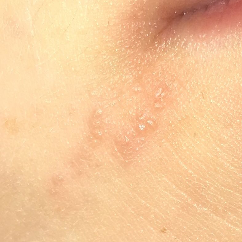 Bläschen Am Mundwinkel Kein Herpes