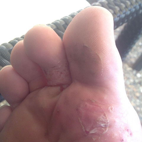 Hier ein Foto des Fußes, es ist nur der rechte Betroffen. - (Arzt, Krankheit, Füße)