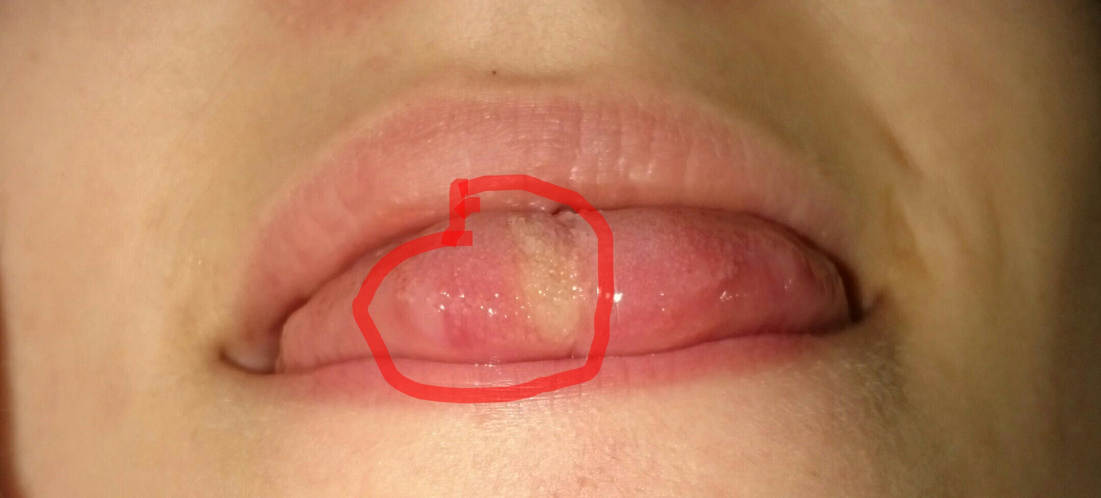 Bläschen an der Zunge Starke Schmerzen (Bild)? (Gesundheit)