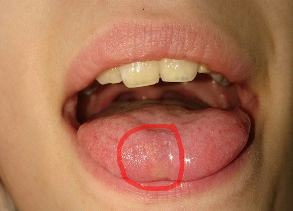 Blaschen An Der Zunge Starke Schmerzen Bild Gesundheit Blaschen An Der Zunge Starke Schmerzen Bild Gesundheit