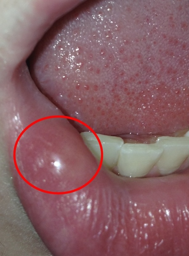 Get Pickel An Der Lippe Geschwollen Background