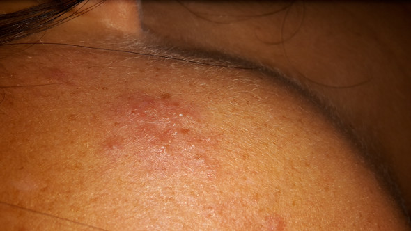 Blaschen Auf Der Haut Was Ist Das Was Tun Gesicht Hautarzt Ausschlag Blaschen Auf Der Haut Was Ist Das Was Tun Gesicht Hautarzt Ausschlag