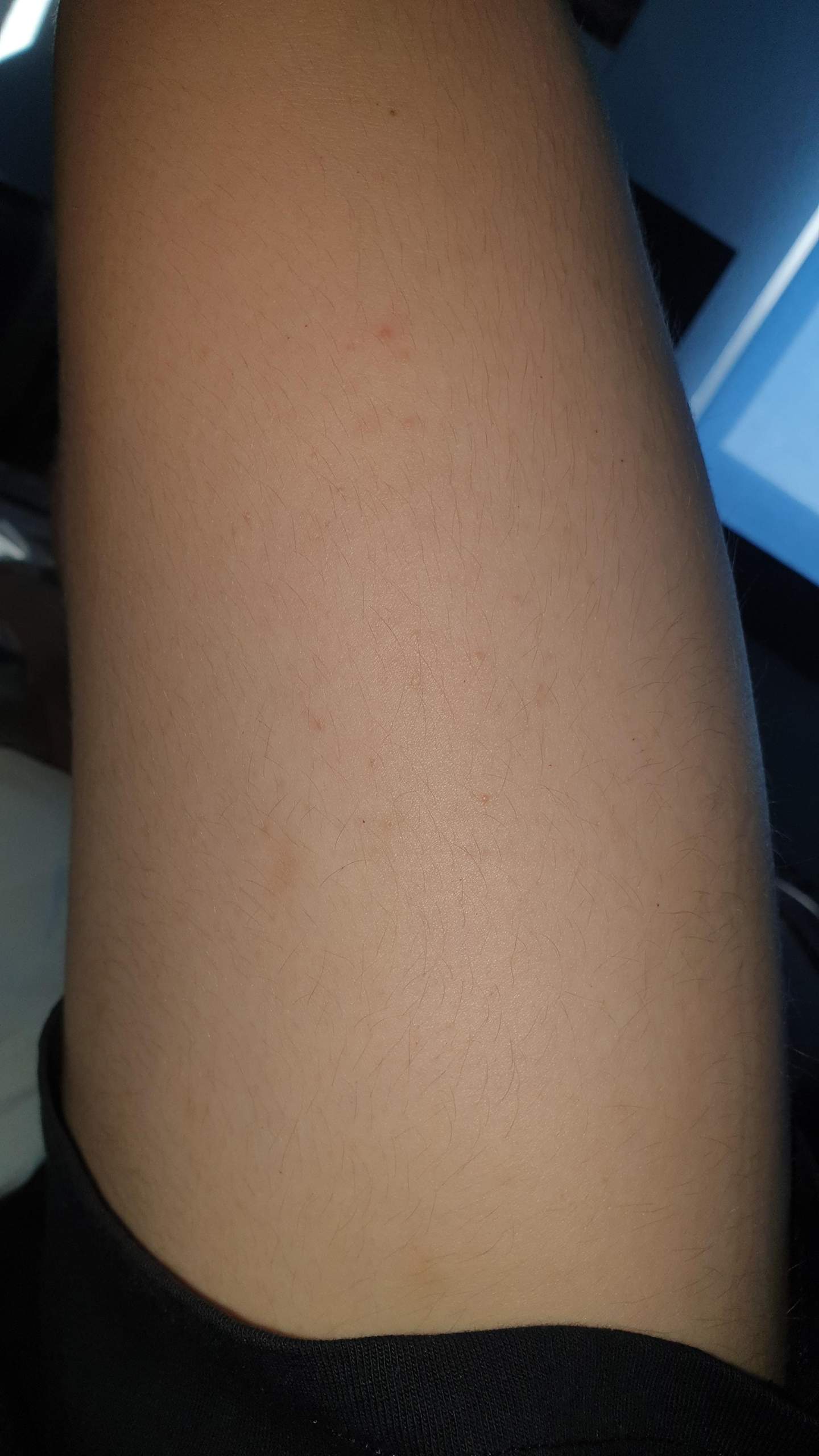 Bläschen auf der Haut? (Gesundheit und Medizin, blaeschen)