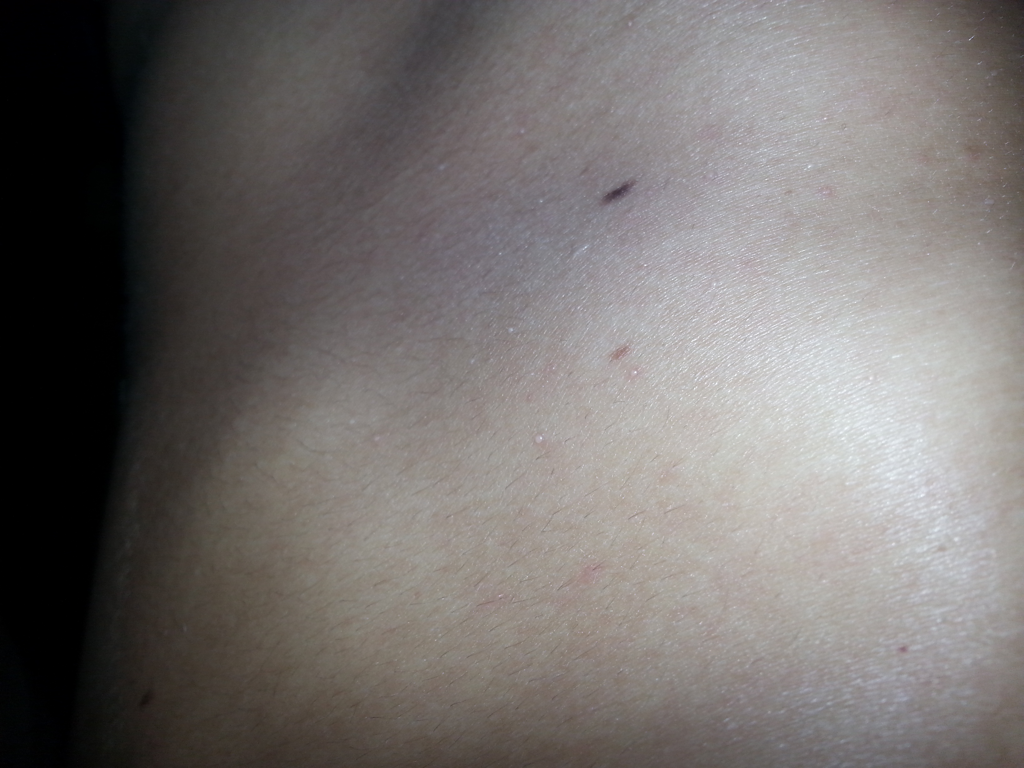 Bläschen auf der Haut, statt schwitzen? (Bilder) (Körper, Sommer, Sonne)