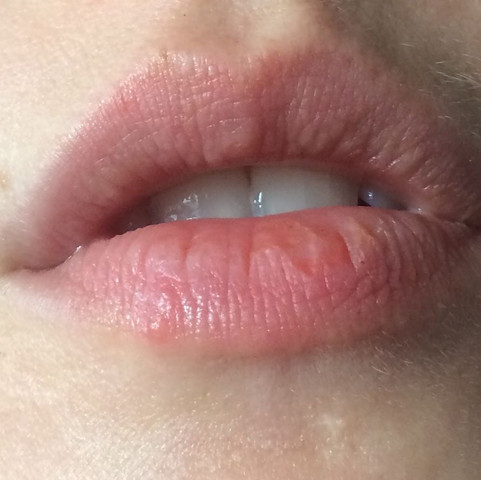 Blaschen Auf Der Unterlippe Ist Das Herpes Lippenherpes Blaschen Auf Der Unterlippe Ist Das Herpes Lippenherpes