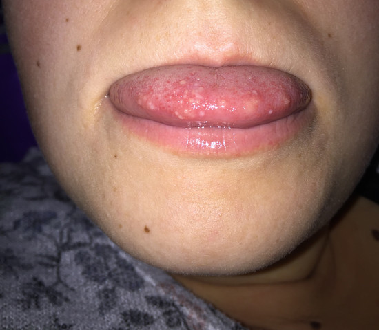 Blaschen Auf Der Zunge Was Kann Das Sein Gesundheit Und Medizin Blaeschen Blaschen Auf Der Zunge Was Kann Das Sein Gesundheit Und Medizin Blaeschen