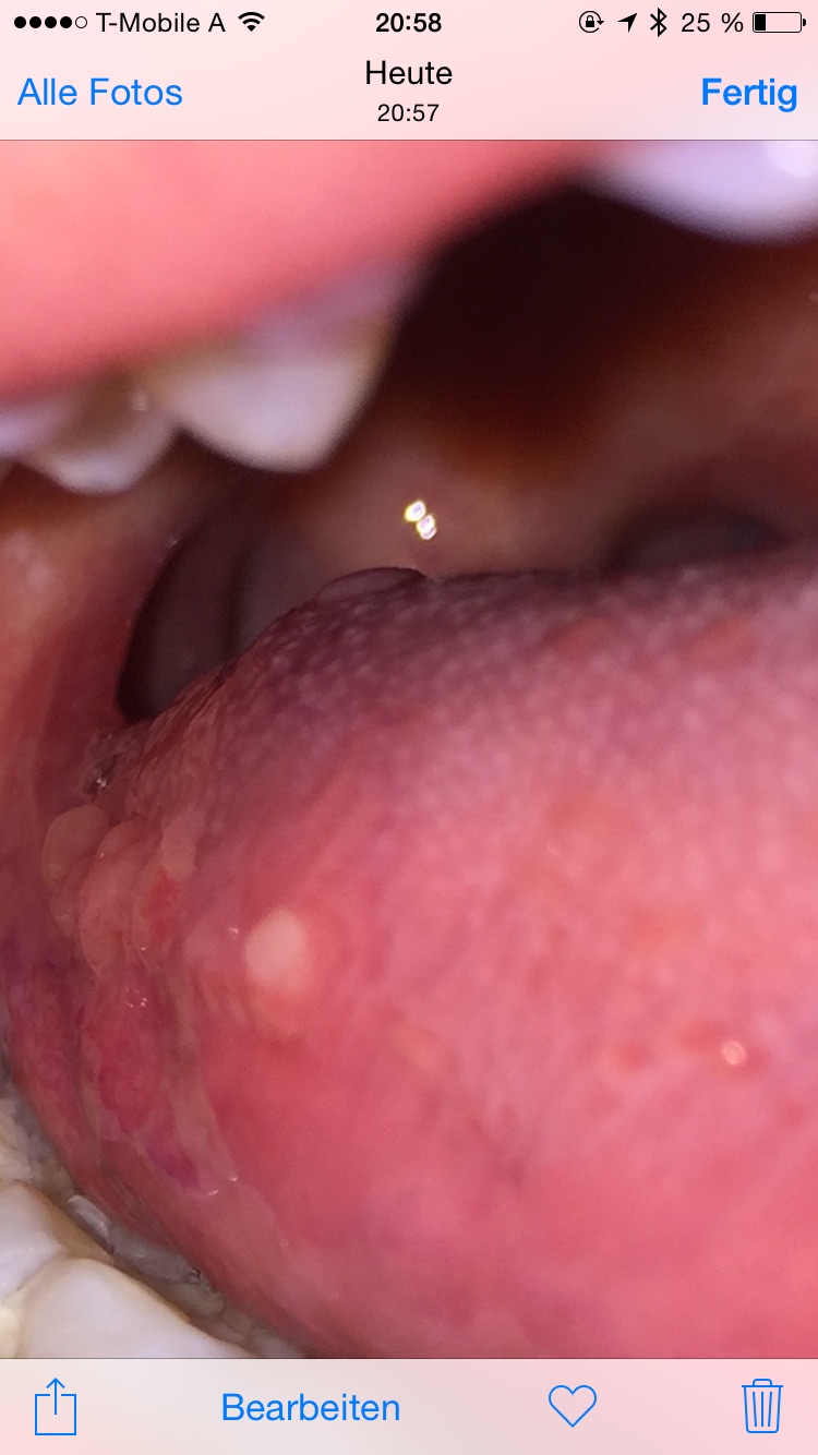 Blaschen Hinten Auf Der Zunge Gesundheit Betrogen Blaeschen Blaschen Hinten Auf Der Zunge Gesundheit Betrogen Blaeschen