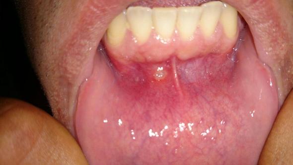 49++ Guertelrose im mund bilder , Bläschen im Mundraum ( Herpes/Gürtelrose ) BILD MIT BILD (Arzt