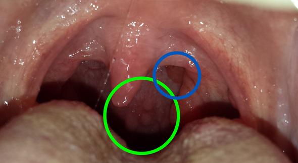 Blaschen Im Rachen Mit Bild Gesundheit Medizin Arzt Blaschen Im Rachen Mit Bild Gesundheit Medizin Arzt