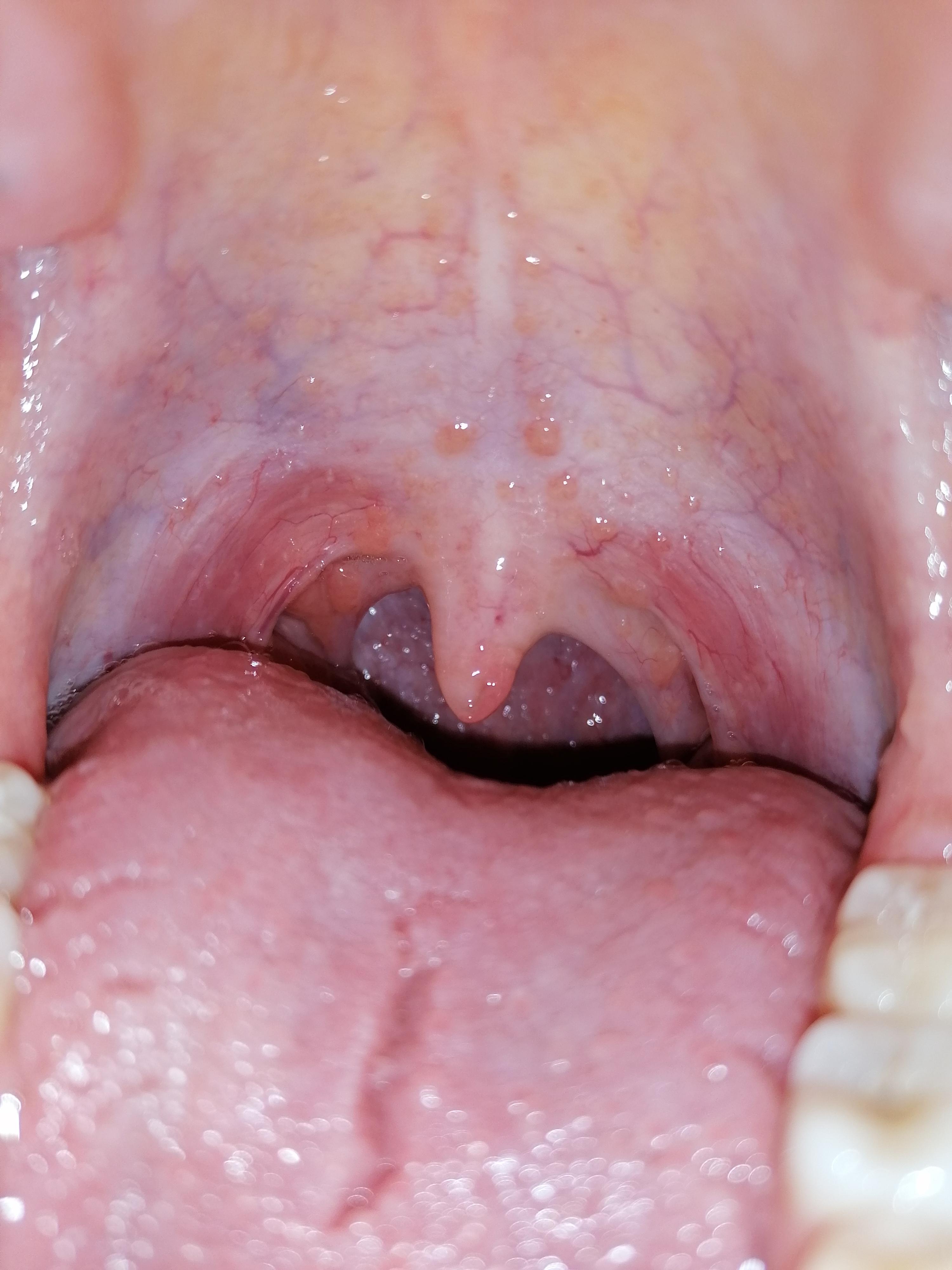 45++ Blaeschen im urin bilder , Bläschen im rachenbereich? (Gesundheit, blaeschen)