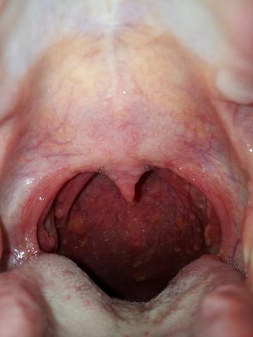 Blaschen Im Rachenraum Gesundheit Medizin Schmerzen Blaschen Im Rachenraum Gesundheit Medizin Schmerzen