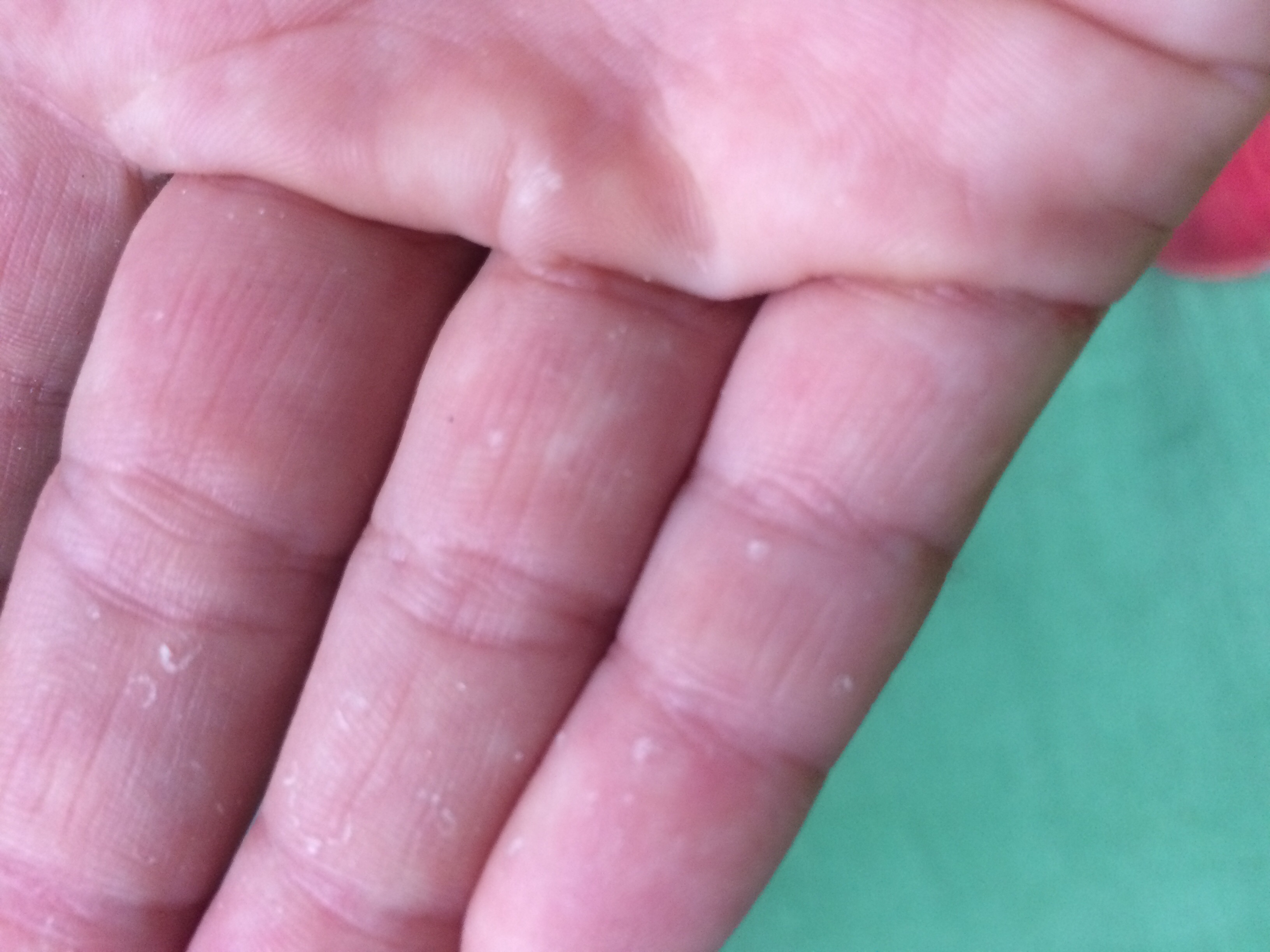 Blase Am Finger Was Tun primitiveinspire Blase Am Finger Was Tun primitiveinspire