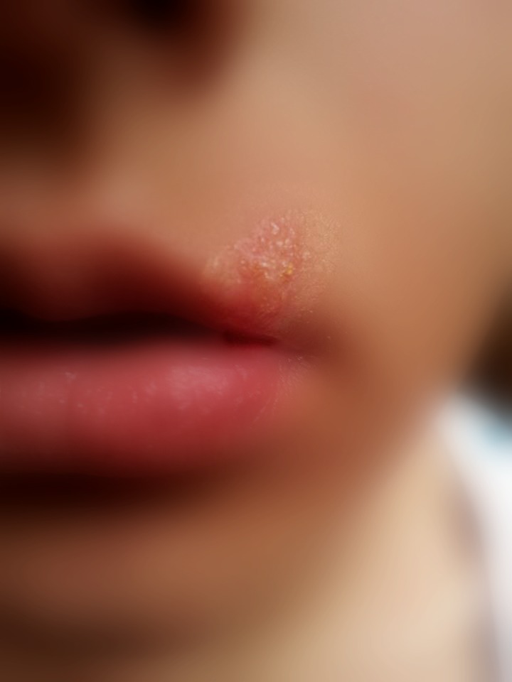 bläschen über der lippe (Blase)