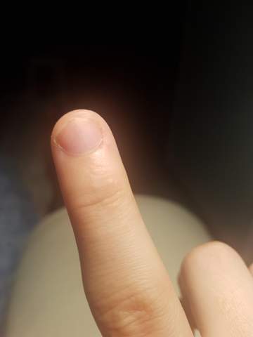 Blaschen Pickelchen Am Zeigefinger Gesundheit Medizin