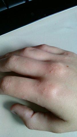 hand 1  - (Gesundheit, Allergie, Hand)