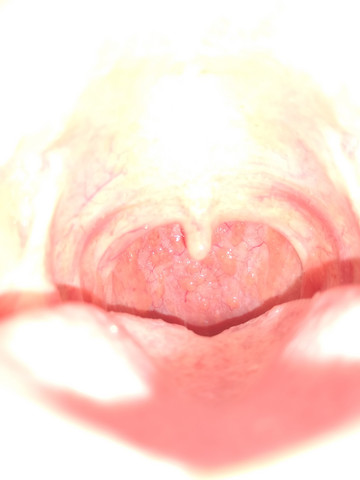 Blasschen Im Hals Was Konnte Das Sein Gesundheit Und Medizin Halsschmerzen Blasschen Im Hals Was Konnte Das Sein Gesundheit Und Medizin Halsschmerzen