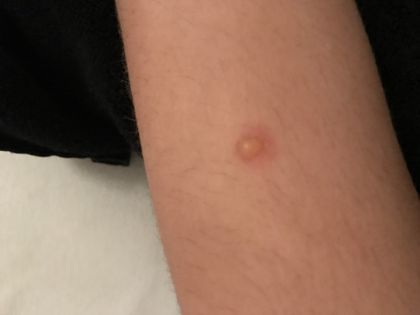 Blase am Arm , von was? (Haut)
