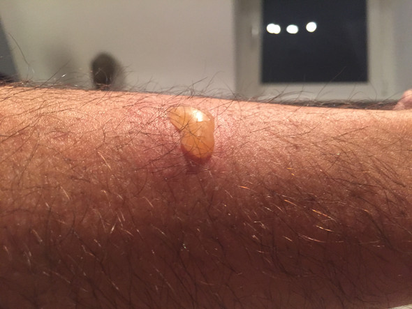 Blase Am Bein Was Konnte Das Sein Medizin Hautarzt Blase Am Bein Was Konnte Das Sein Medizin Hautarzt