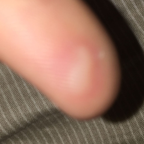 Sorry sieht Einbisschen eklig aus😅 - (Finger, Blase, aufstehen)