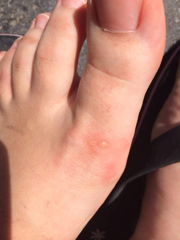 Blase Am Fuss Was Ist Das Medizin Arzt Schmerzen Blase Am Fuss Was Ist Das Medizin Arzt Schmerzen