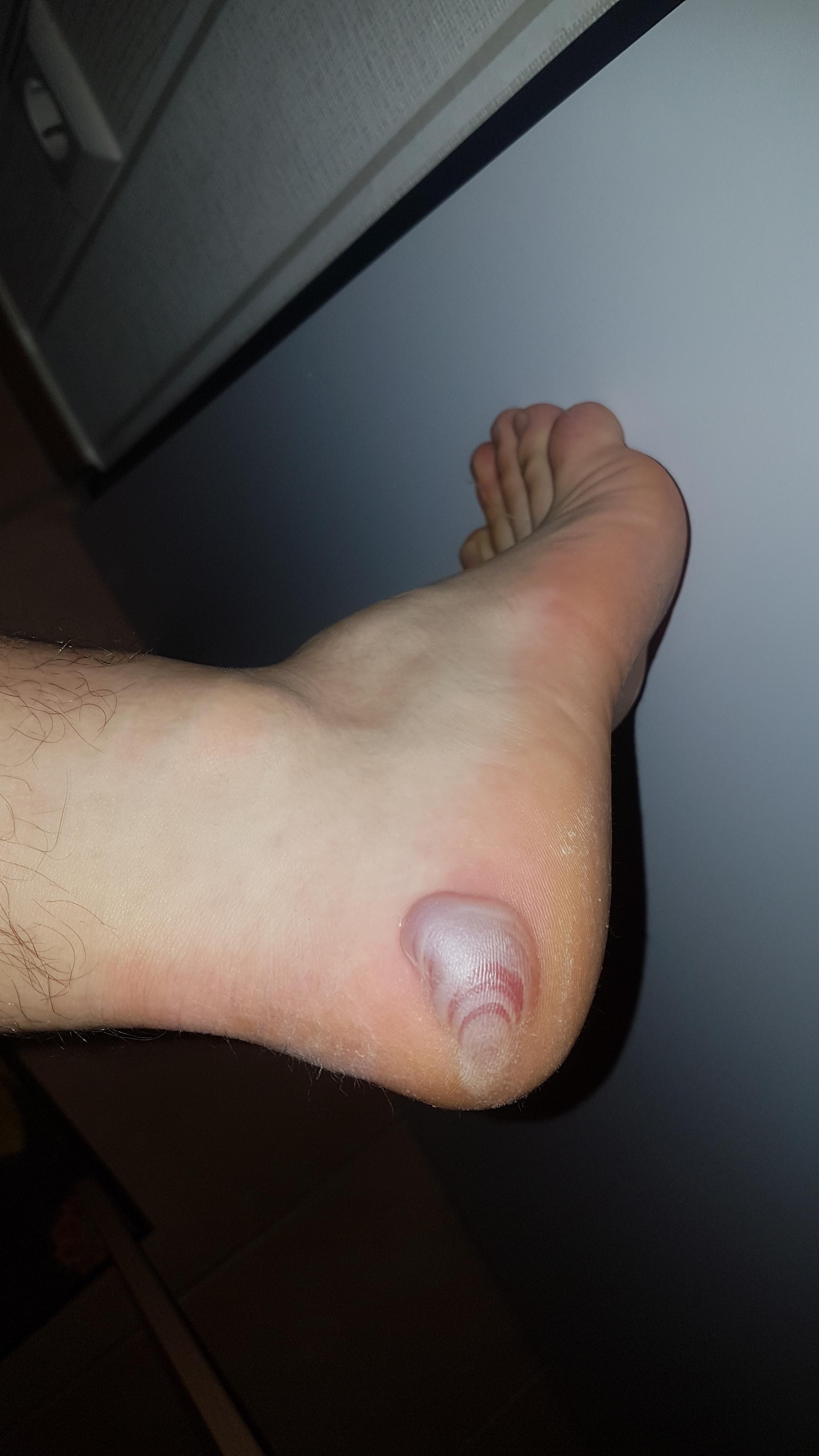 Blase Am Fuss Von Arbeitsschuhen Fusse Blase Am Fuss Von Arbeitsschuhen Fusse