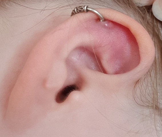 Piercing entzündet was tun helix HELIX PIERCING