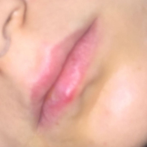 Blase An Der Unterlippe Was Kann Das Sein Gesundheit Und Medizin Krankheit Blase An Der Unterlippe Was Kann Das Sein Gesundheit Und Medizin Krankheit