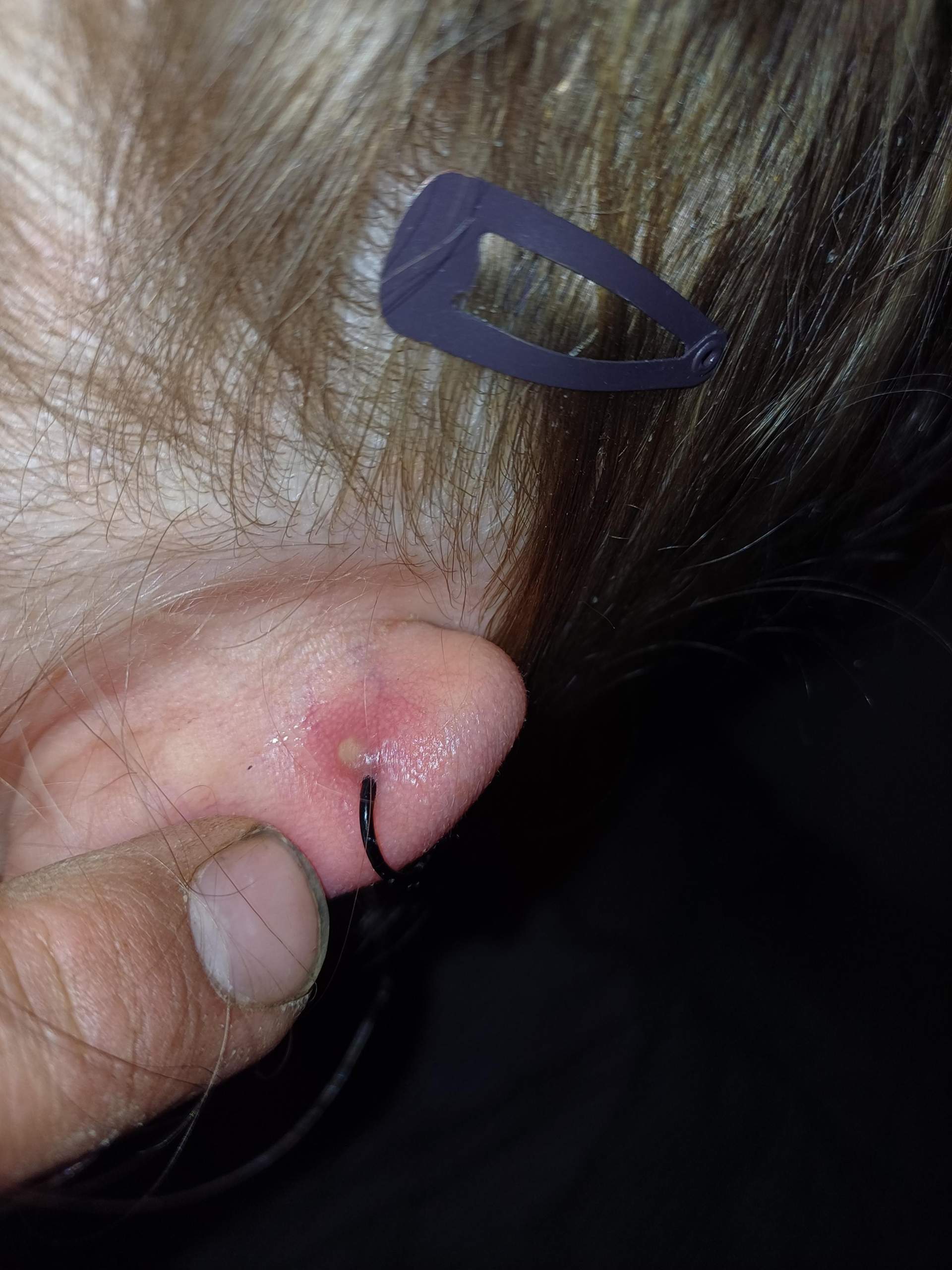 Blase aufstechen? (Schmerzen, Piercing, Entzündung)