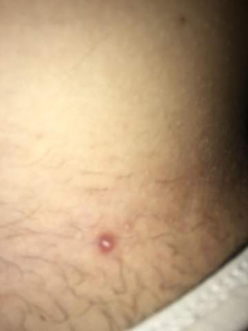 blase im intimbereich gesundheit