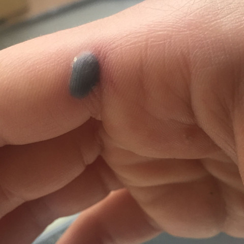Blase Mit Blut Am Zeigefinger Gesundheit Und Medizin Gesundheit Wunde Blase Mit Blut Am Zeigefinger Gesundheit Und Medizin Gesundheit Wunde