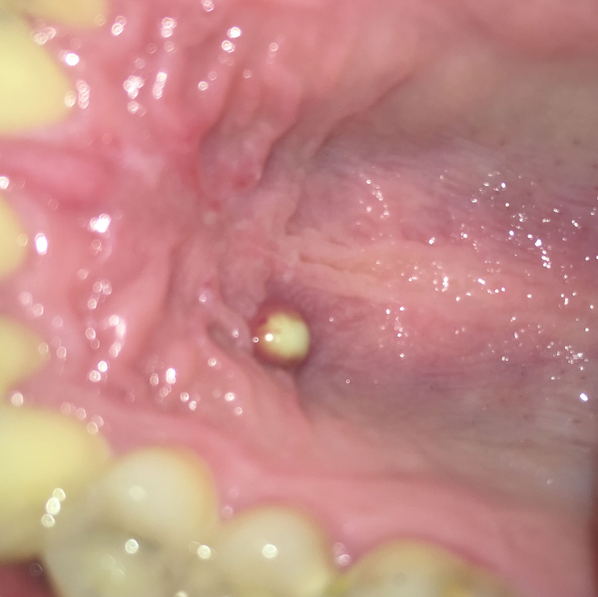 Was ist das für eine Blase mit Eiter am Gaumen? (Gesundheit und Medizin Was ist das für eine Blase mit Eiter am Gaumen? (Gesundheit und Medizin
