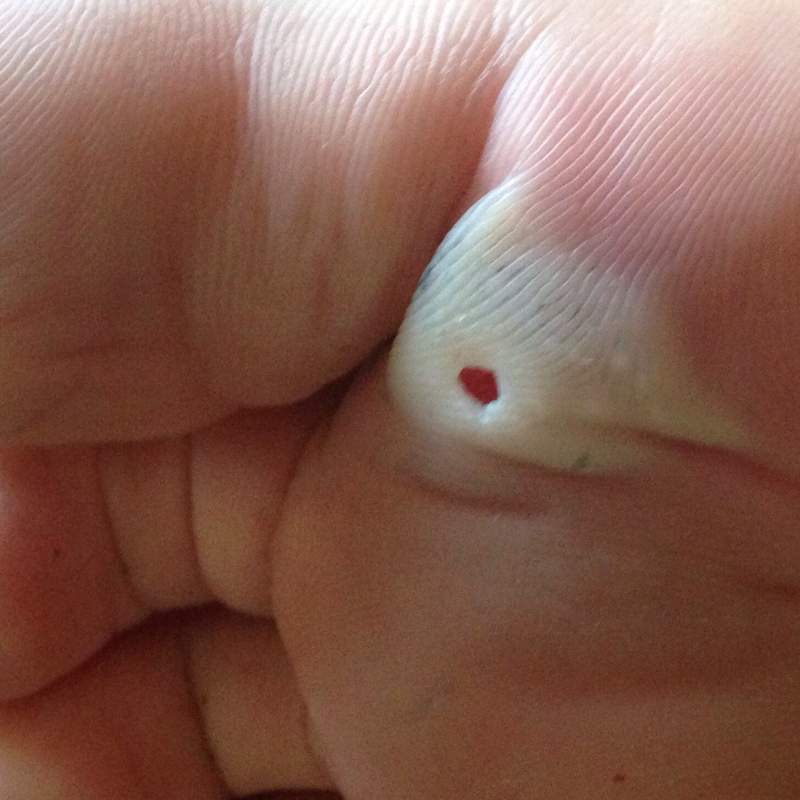 Blase Unter Dem Fuss Schmerzen Fusse Blase Unter Dem Fuss Schmerzen Fusse