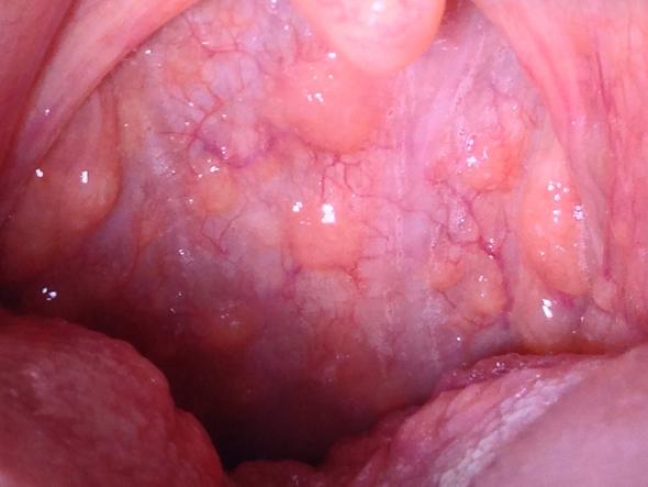 Get Pickel Im Mundraum Images