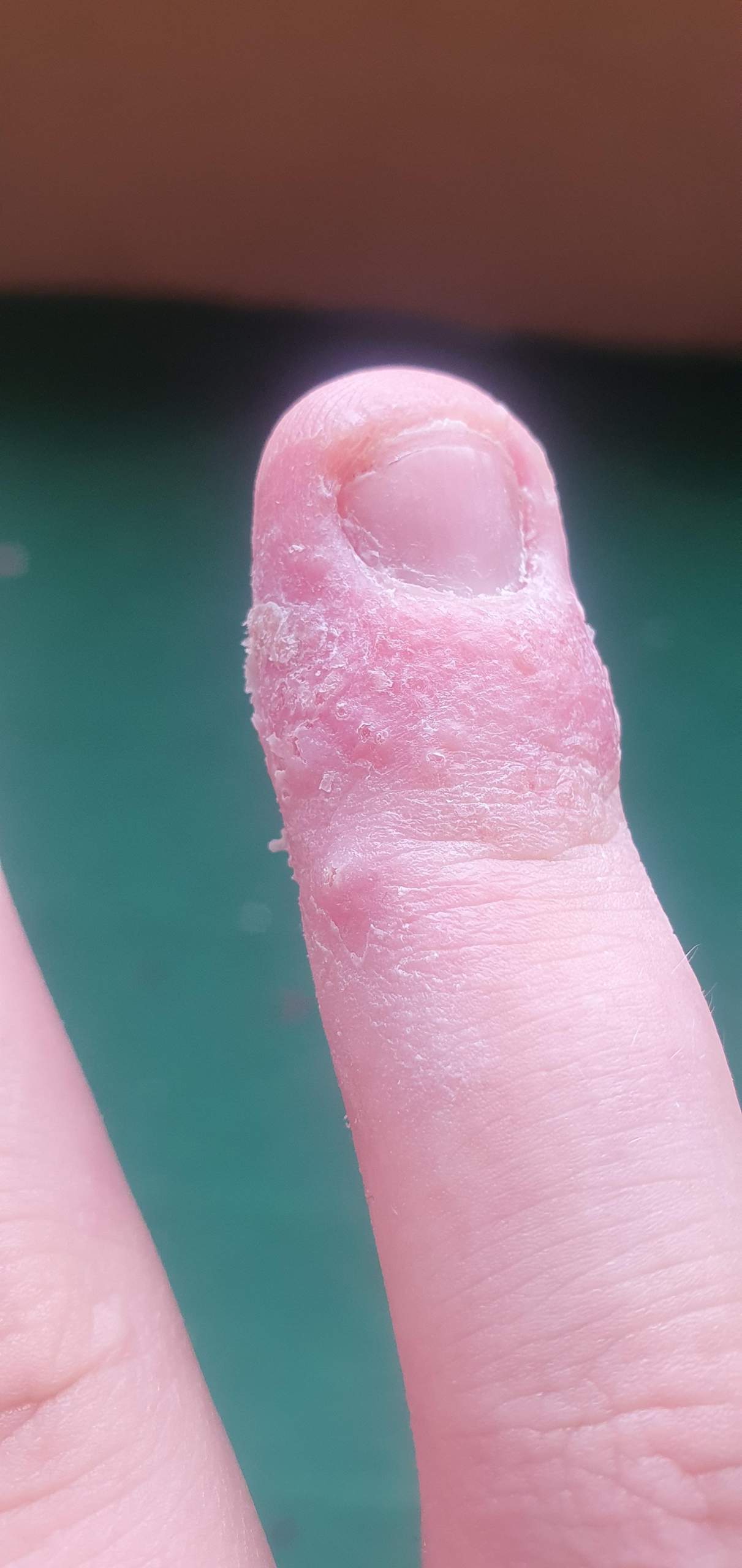 Blasen am Finger? (Haut)